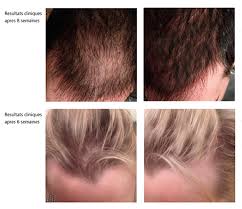 Medical JETOP - Cheveux homme et femme (avant / après)